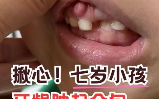 儿童牙龈鼓包是上火还是炎症？不同情况该怎么处理？