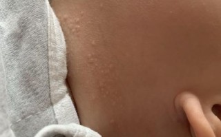新生儿身上出现白色疙瘩是正常现象还是疾病信号？