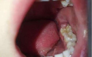 孕期尽头牙肿痛怎么办？孕妇安全缓解牙痛的实用方法有哪些？