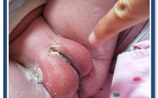 新生儿尿道口下裂具体表现有哪些？