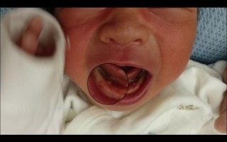 新生儿两边大牙床发白是正常现象还是异常信号？需要警惕哪些问题？