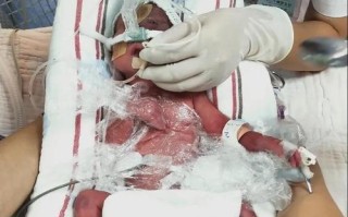 新生儿呼吸窘迫综合征的早期识别与治疗关键是什么？