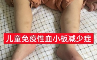 儿童低血压有哪些常见症状？不同年龄段表现有何差异？
