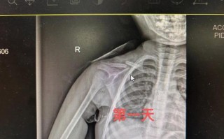 新生儿右锁骨骨折图片，是分娩损伤还是医疗疏忽？如何判断与应对？