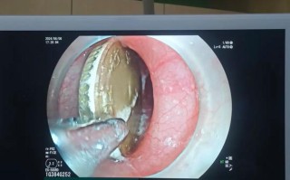 儿童胃镜取硬币痛苦吗？麻醉安全吗？家长该如何做？