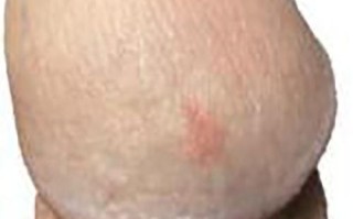 新生儿龟头炎初期照片有哪些典型症状？家长该如何正确护理？