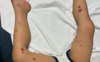 儿童过敏性紫癜图片长啥样？早期症状和皮疹特征有哪些？