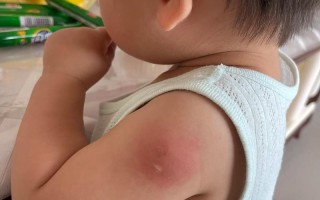 新生儿打疫苗后胳膊发红是正常反应吗？需要如何护理？