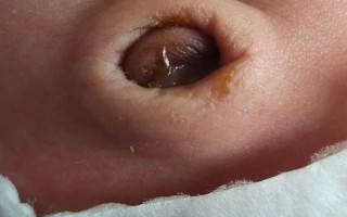 新生儿二次断脐是更科学还是 unnecessary 风险？真的有必要尝试吗？