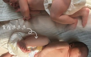 新生儿黄疸晒太阳，正确姿势、时间、部位及注意事项有哪些？