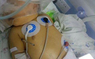 新生儿溶血性黄疸住院