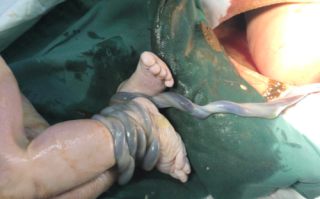 怀孕期间死胎会有哪些症状表现？孕妇该如何及时察觉异常？