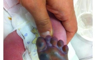 新生儿败血症有哪些典型症状？通过图片解析如何早期识别这种危险的感染信号？