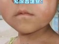 儿童脸上长白斑图片是什么原因？需要警惕哪些疾病？
