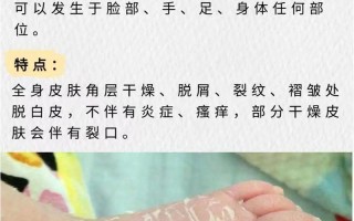 新生儿脱皮要怎么护理