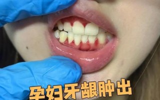 怀孕期间牙龈红肿出血