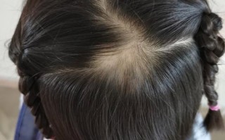 新生儿头顶为何会掉头发？是正常生理现象还是异常信号？