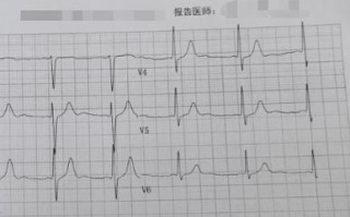 孕期心电图出现短PR间期，对胎儿健康会有哪些潜在影响？
