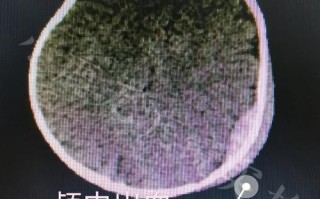 新生儿颅内出血普遍吗？其发生率、高危因素及早期识别方法有哪些？