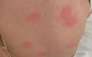 儿童出疹子常见症状有哪些？不同疹子症状差异大吗？如何判断是否需要就医？