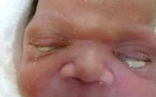 新生儿眼角红有分泌物