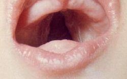 孕期情绪波动是否真的会导致胎儿兔唇？科学依据在哪里？