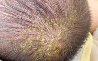 新生儿头上没有头垢是不是不正常？需要担心吗？