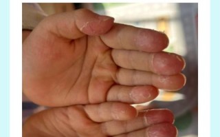 儿童手指肚脱皮是缺乏营养还是皮肤病？该如何正确护理与处理？