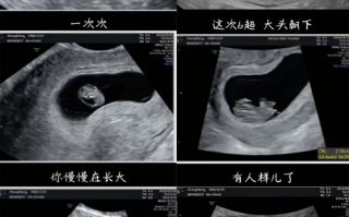 孕期十几次B超，真的有必要吗？