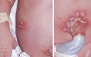 新生儿大疱表皮松懈症，为何出生即起疱，该如何科学应对与护理？