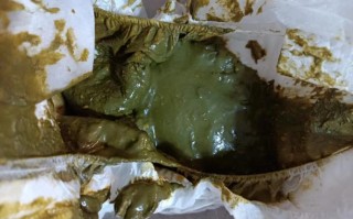 儿童大便绿色怎么回事