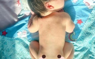 新生儿黄疸晒太阳晒哪个部位？