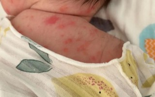 新生儿红斑消退过程是自然现象吗？需要家长如何正确护理？