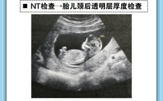 孕期做NT检查具体是查什么？对胎儿发育有何意义？