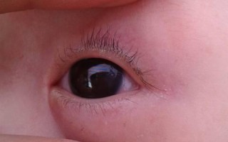 新生儿黑眼球发灰是正常现象还是异常信号？需警惕哪些眼部问题？