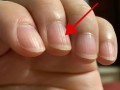 10岁儿童指甲出现竖纹是营养不良还是疾病信号？