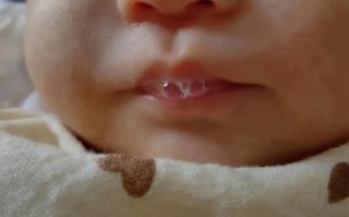 新生儿嘴巴上的白泡是正常现象还是疾病信号？需要处理吗？
