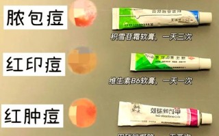 孕期长痘，用药安全吗？