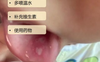 新生儿口腔溃疡的治疗