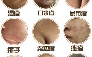 新生儿痤疮能快速消退吗？