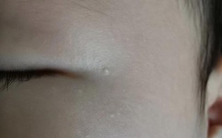 新生儿眼角白色东西是眼屎还是其他眼部问题？