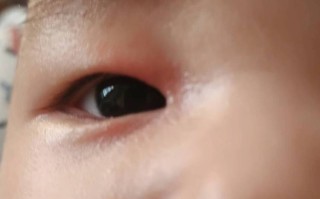 新生儿眼皮红印是什么原因？需要担心吗？