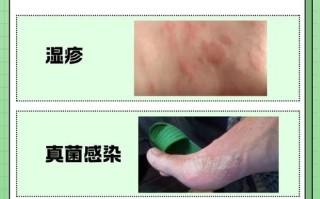 孕期湿疹发作难受，用盐水洗能缓解还是加重风险？