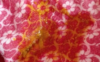 新生儿宝宝粑粑有红色是正常现象还是疾病信号？