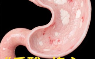 怀孕期间感染幽门螺旋杆菌会对胎儿造成哪些影响？