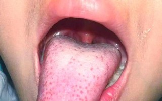 缺锌儿童舌头会出现哪些典型症状？附真实图片对比解析。