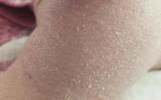 新生儿湿疹皮肤粗糙硬硬的，是严重了还是护理方式错了？