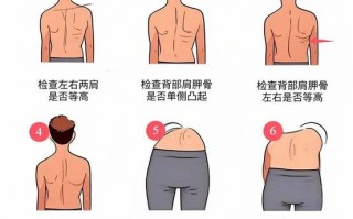 儿童肩胛骨突出是缺钙还是姿势问题？家长该如何科学应对？