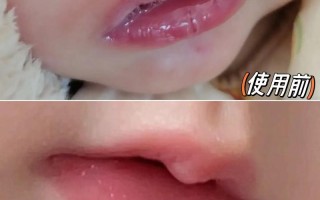 新生儿嘴唇脱皮是缺水还是疾病？日常护理该注意什么？