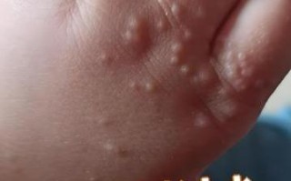 新生儿手脚长水泡是正常现象吗？需要担心什么疾病吗？